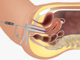 Gebärmutterspiegelung (Hysteroskopie) in der Gynäkologischen Praxisklinik München – Schonende und präzise Behandlung